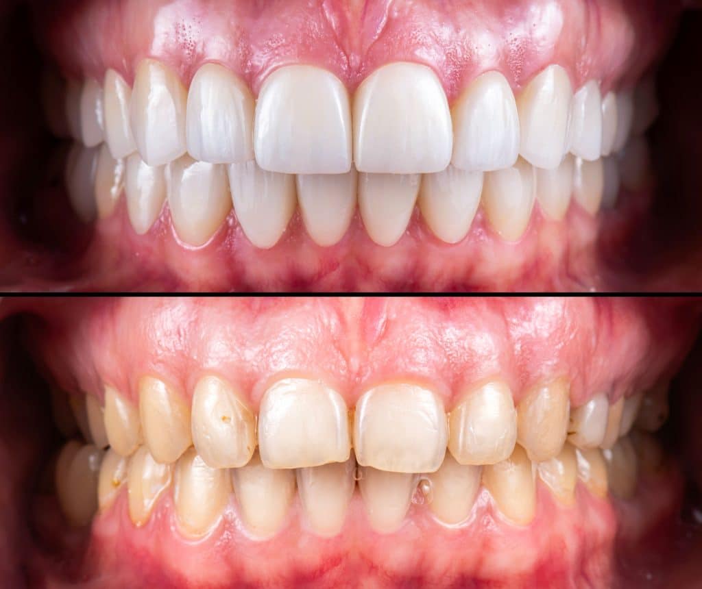 Before and After