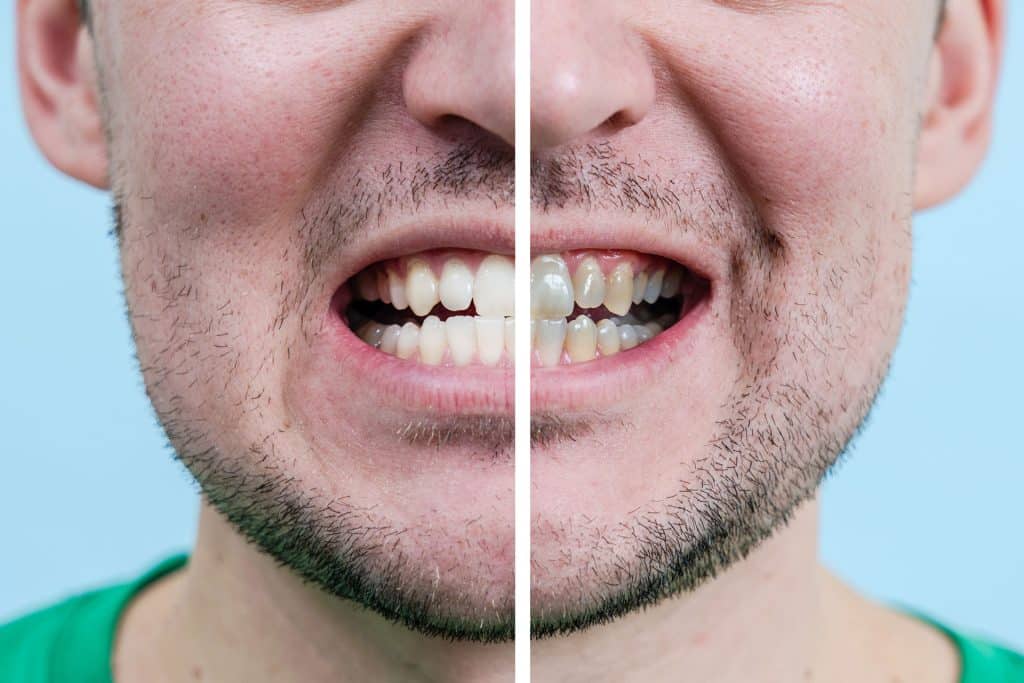 Teeth Whitening in Miami