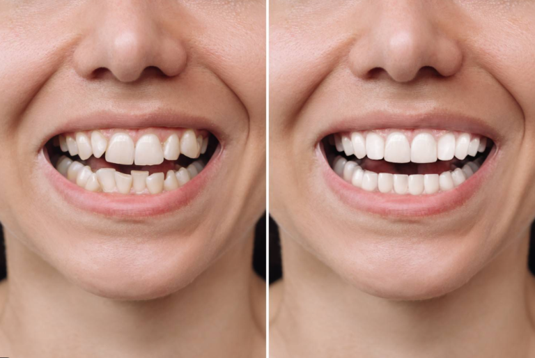 Veneers Before and After: Read Real Results and Choose With Confidence