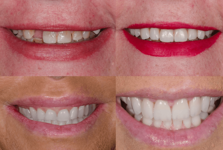 Veneers Cost Explained: Key Factors, Options, and How to Choose With Confidence