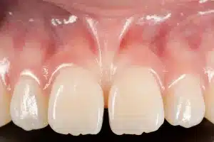 Ask the Dentist: The Questions Patients Should Ask Before Starting Veneers, Implants, or Invisalign This Summer