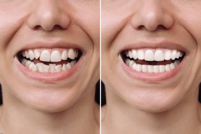 Veneers Near You: How to Choose the Right Dentist Through Real Results